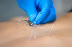 Séance de Dry Needling au Centre Bayane de Rabat