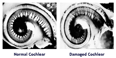 diagram showing damaged cochlear