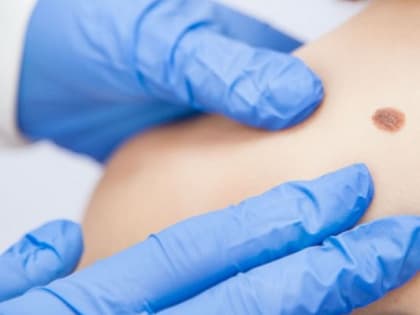 Диагностировать новообразования кожи поможет цифровой врач