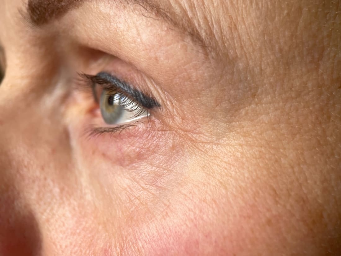 Close view of a woman’s eye with heavy, hooded upper-eyelid skin