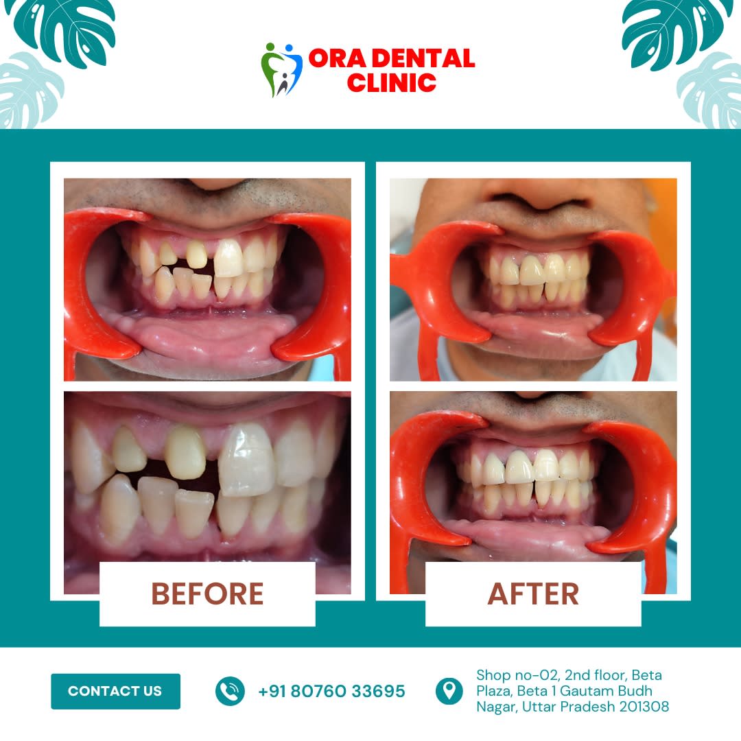 Ora Dental & Implant Clinic - Dentist In Greater Noida | RCT | Wisdom Tooth Extraction thumbnail 3