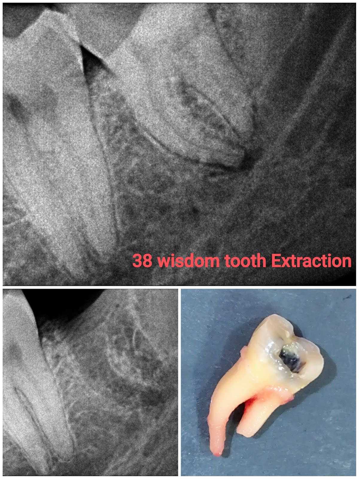 Ora Dental & Implant Clinic - Dentist In Greater Noida | RCT | Wisdom Tooth Extraction photo 4