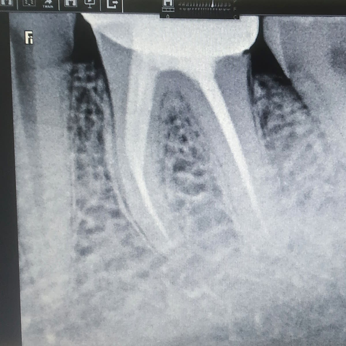 Ora Dental & Implant Clinic - Dentist In Greater Noida | RCT | Wisdom Tooth Extraction photo 5