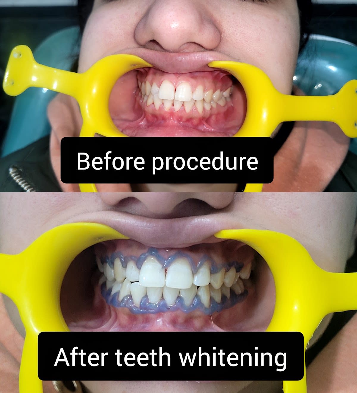 Center Of Dental Treatment (RCT, Implants, Zirconia Crowns ,Smile Designing, Wisdom Tooth Extractions) 20 Years Of Experience photo 4