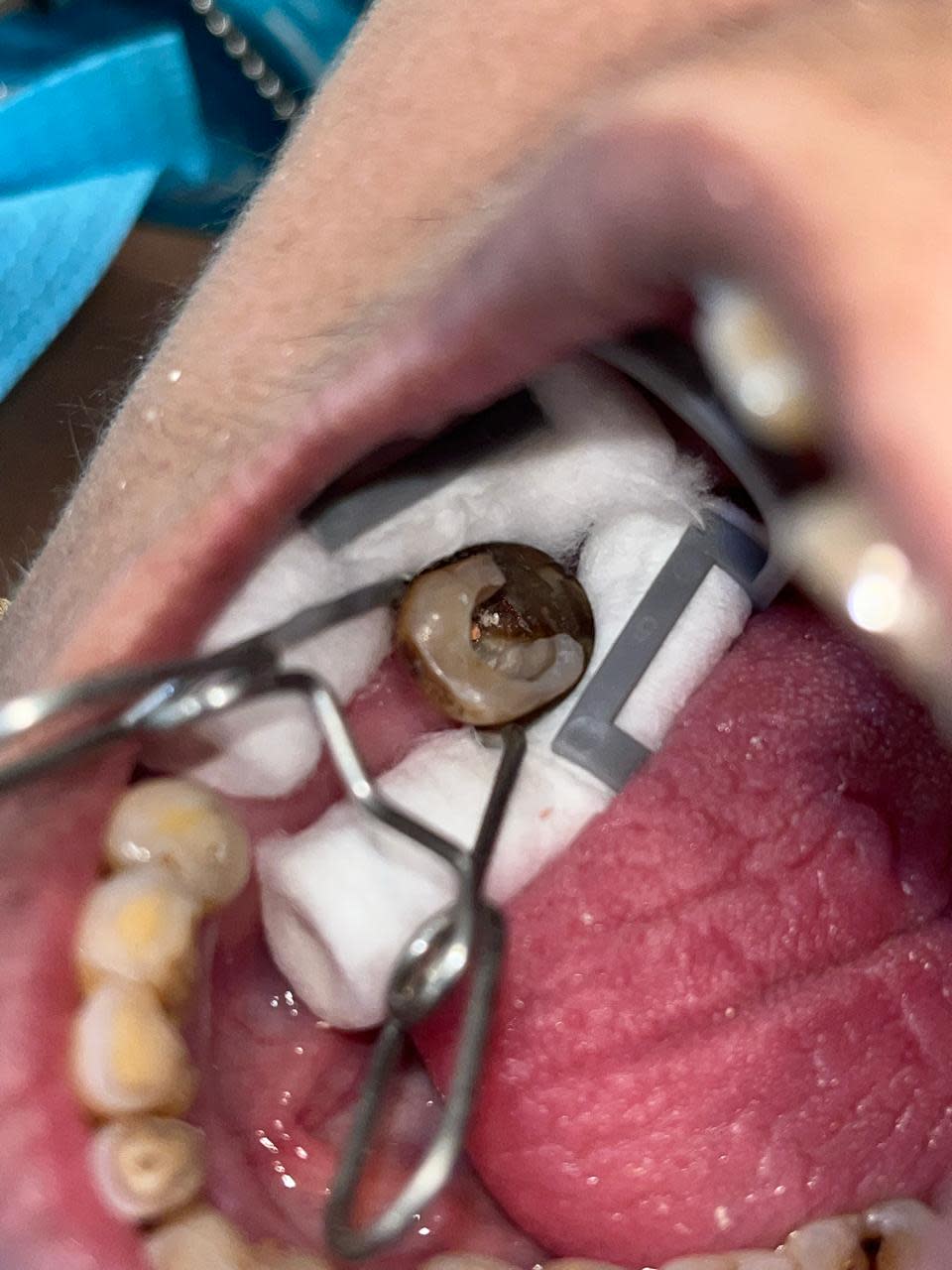 Radiant Roots Dental And Implant Clinic |Dentist In Techzone 4| Root Canal Treatment (RCT)| Extraction| photo 5