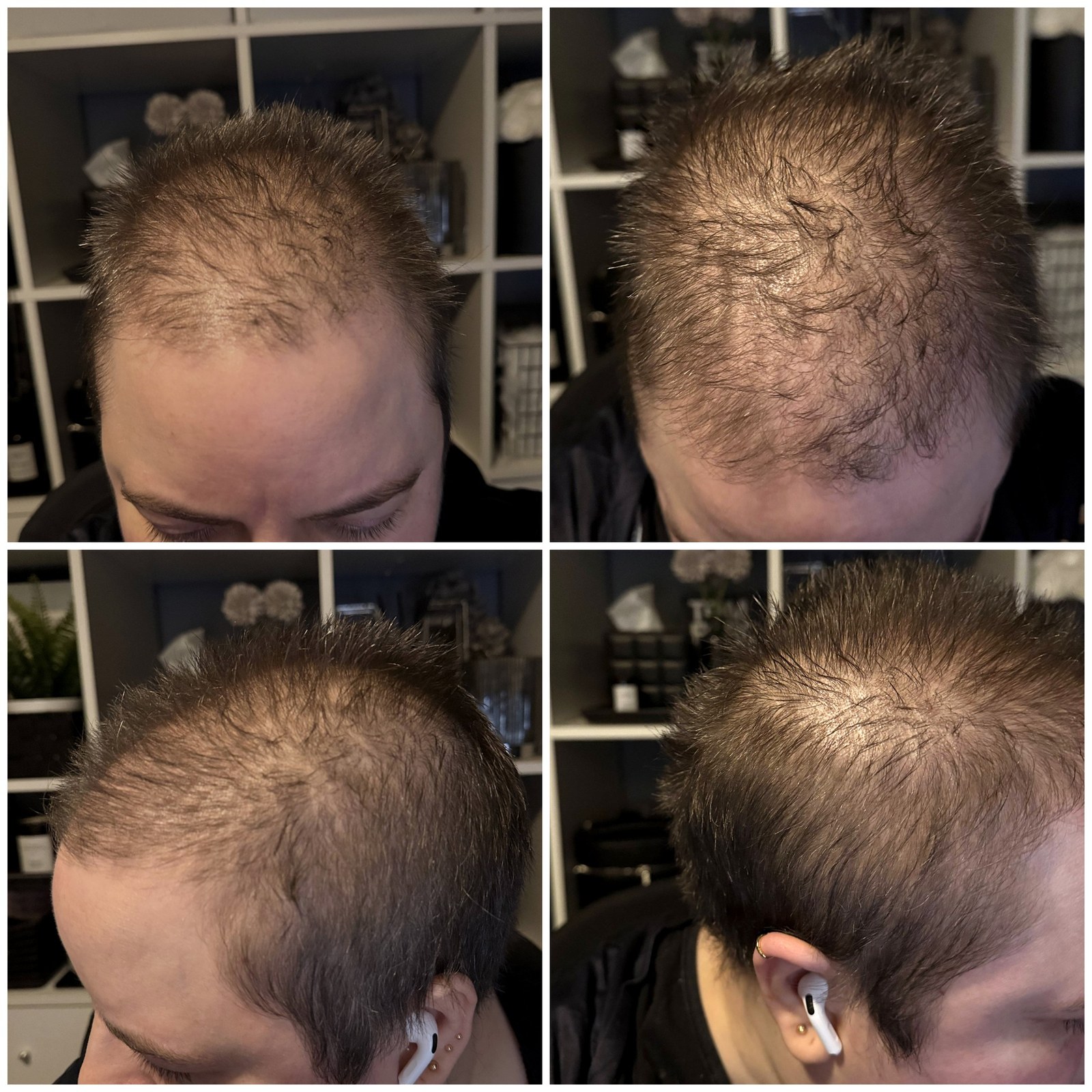 Four angles of Neveen's scalp in August 2026, at the start of using the Hair + Me Drops, two from the front and two from the side.