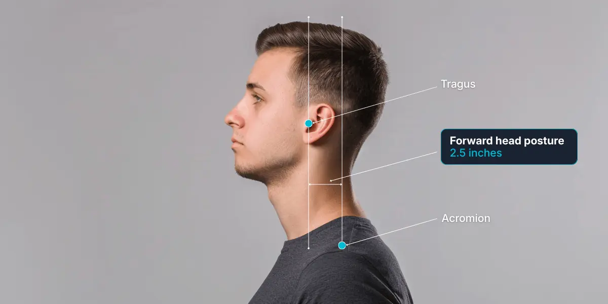 Forward head posture measurement showing 2.5 inch distance between tragus and acromion with anatomical landmarks labeled