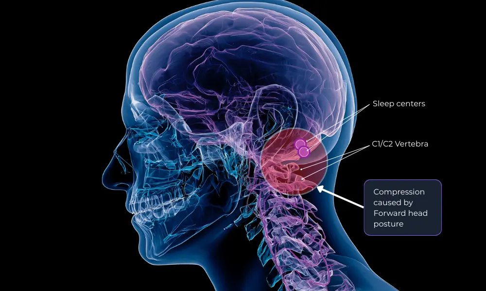 Annotated anatomical diagram showing how forward head posture causes compression at C1/C2 vertebrae affecting sleep centers in brainstem