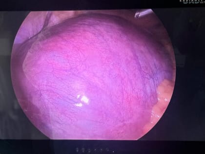 Операция по удалению опухоли яичника во время беременности