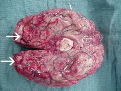 Роспотребнадзор рассказал о заражении «пожирающей мозг» амебой