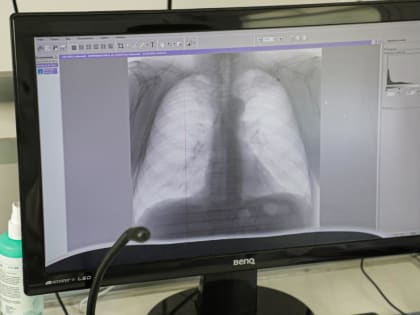 В Тюменской области раком легкого или трахеи чаще болеют мужчины, чем женщины