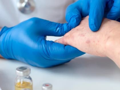 В Тюменской области выявлены новые случаи заражения корью