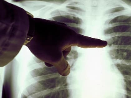 Врачи рассказали тюменцам о симптомах и профилактике рака легкого