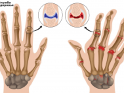 День осведомленности о ревматоидном артрите