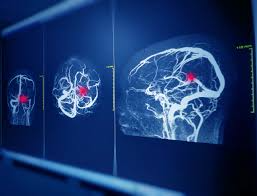 AI system detects brain aneurysms