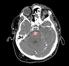 Detector spots brain aneurysms via AI