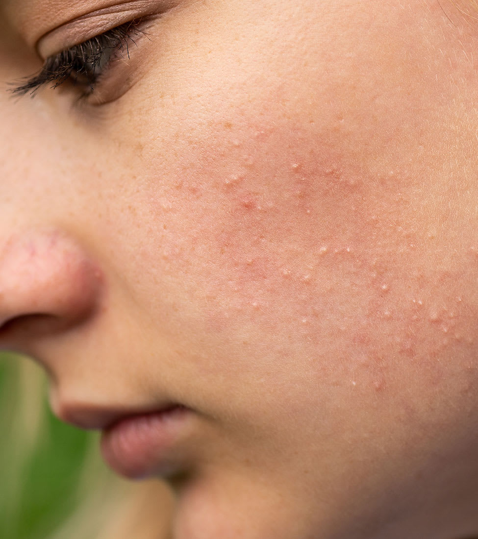 The-Best-Cleansers-For-Acne-Prone-Skin
