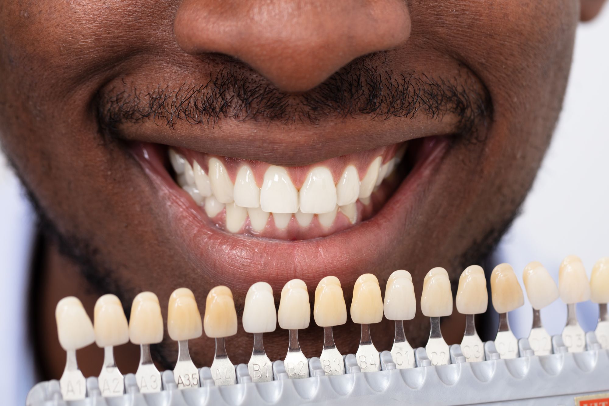 Veneers