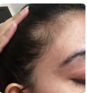 Hair Loss