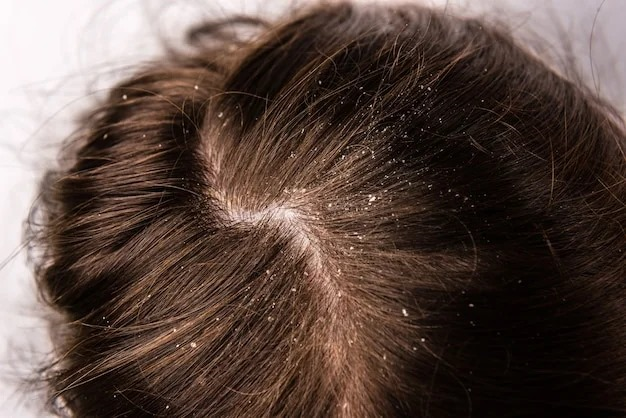 Dandruff and Greasy Scalp