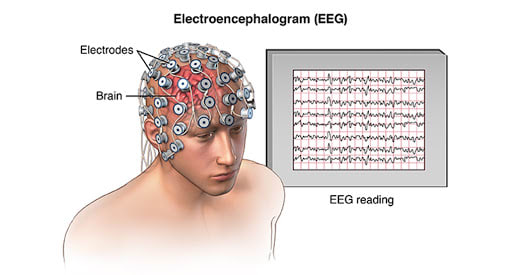 eeg sleep study