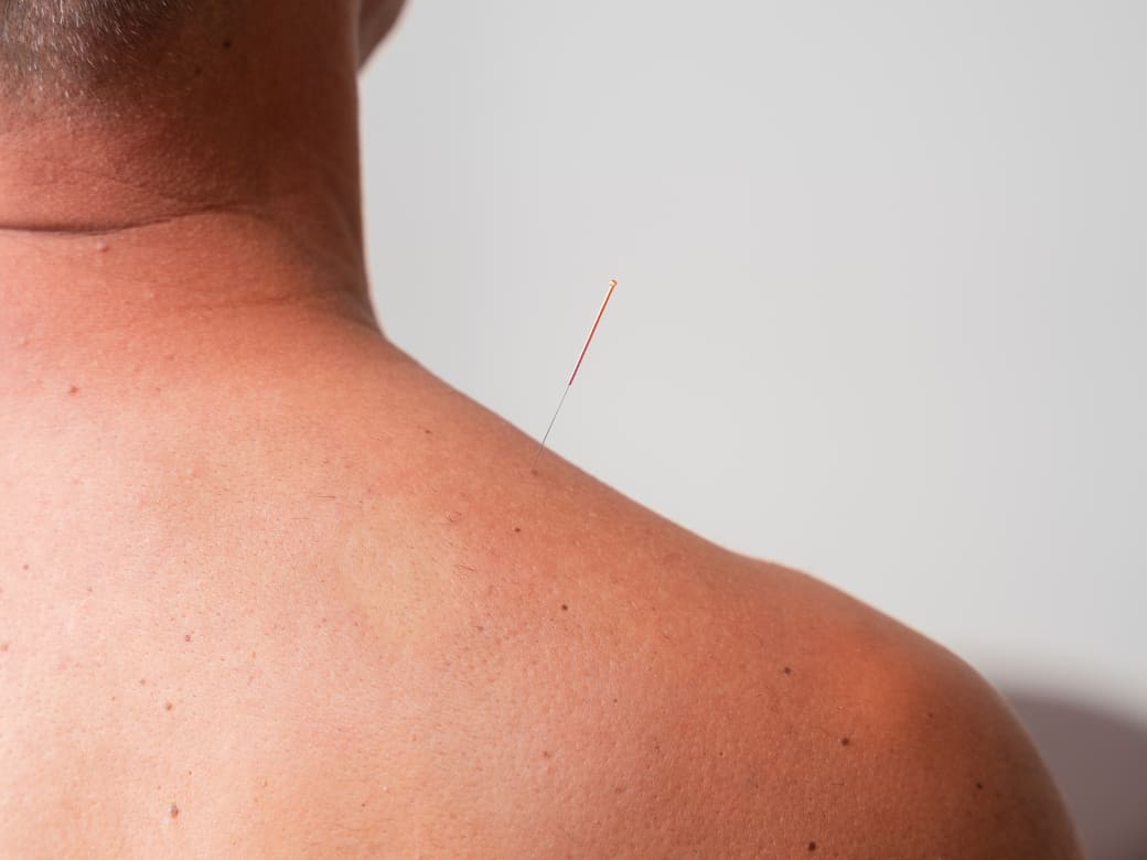 A single acupuncture needle in place on a patient's shoulder, showing how fine it is