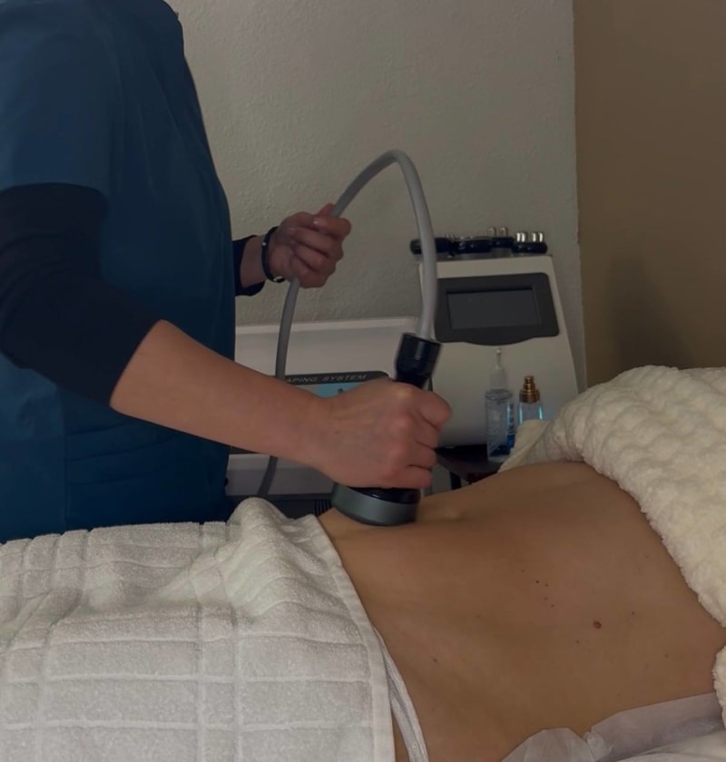 RF skin tightening treatment at Sculpt and Glow San Diego