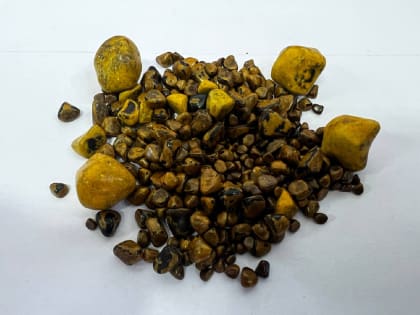 Жительнице Коломны удалили жёлчный пузырь, в котором нашли более 200 камней