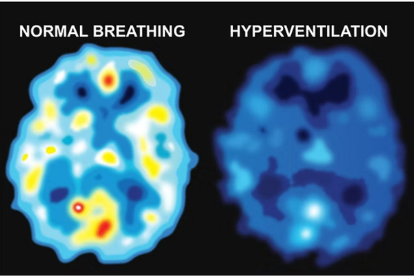 Hyperventilation effects