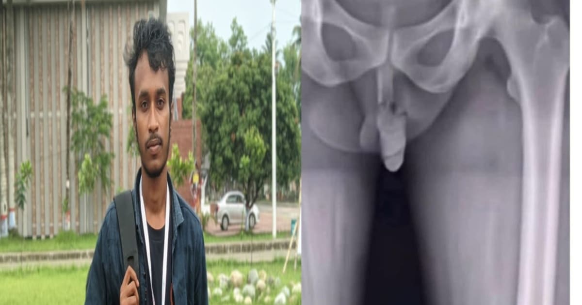 বন্ধু @shimul এর পায়ে তীব্র আঘাত লেগেছে। সবাই ওর সুস্থতা কামনা করবেন।