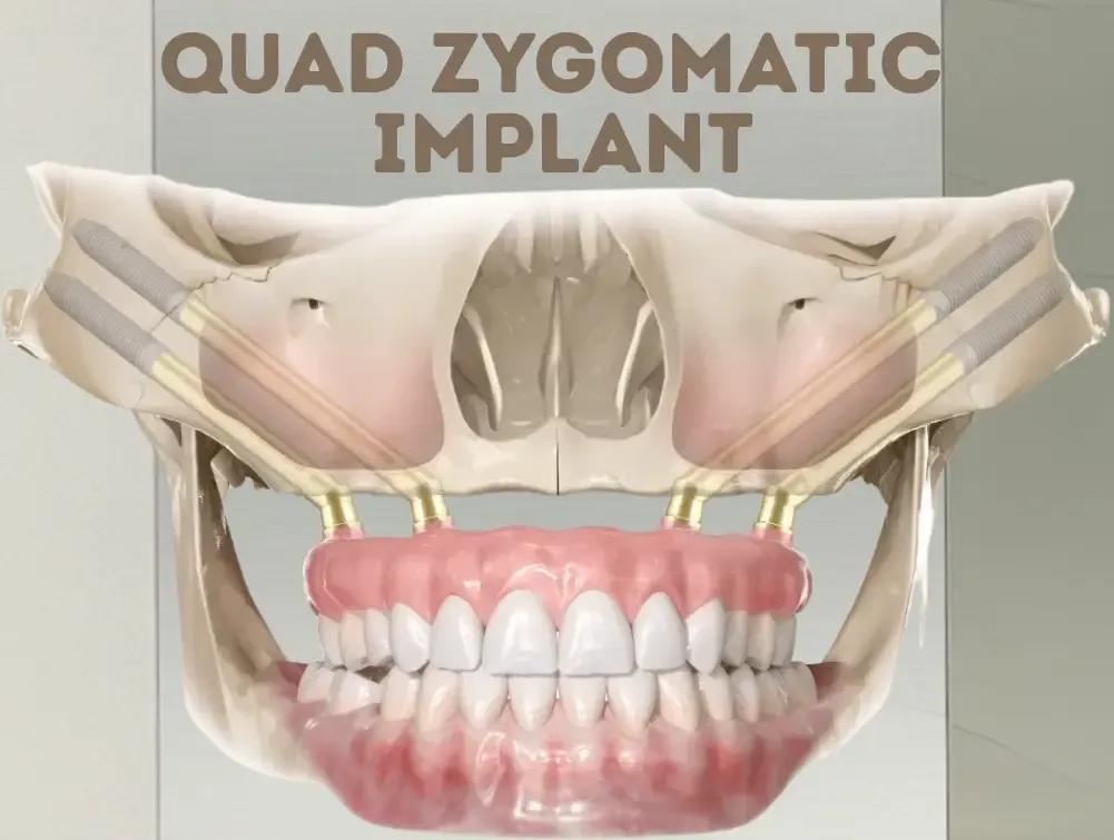 Specialist-Led Dental Implants in the Heart of Istanbul