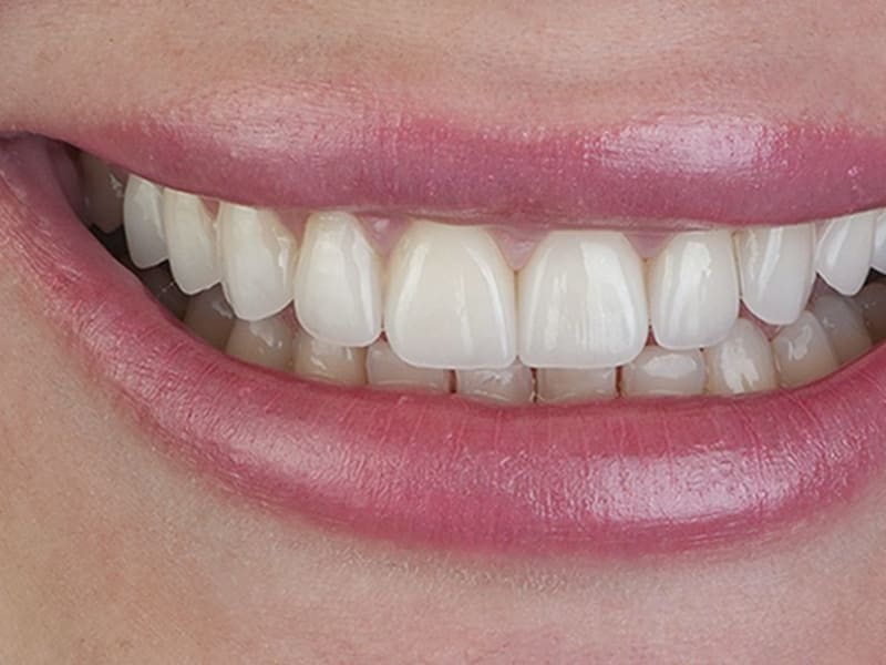 After dental treatment - Patient case 3 showing successful treatment results