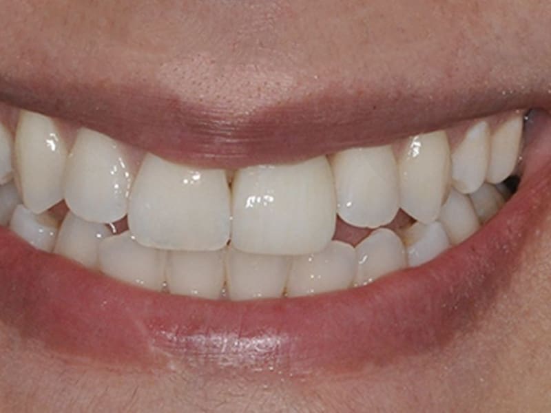 After dental treatment - Patient case 1 showing successful treatment results