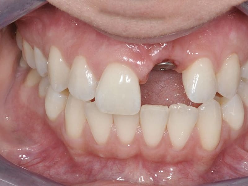 Before dental treatment - Patient case 1 showing initial condition
