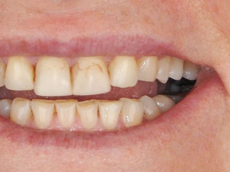 Before dental treatment - Patient case 2 showing initial condition