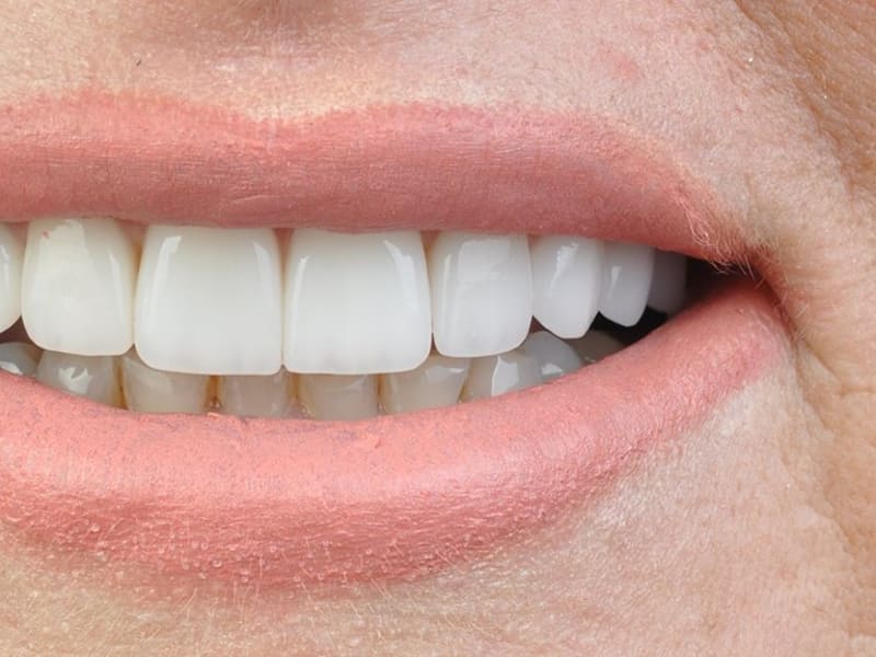 After dental treatment - Patient case 2 showing successful treatment results