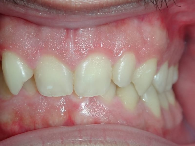 Before dental treatment - Patient case 1 showing initial condition