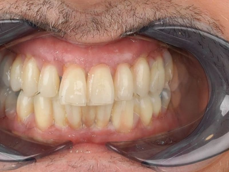 Before dental treatment - Patient case 3 showing initial condition