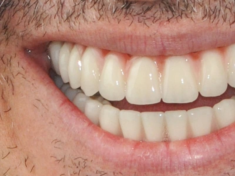 After dental treatment - Patient case 3 showing successful treatment results