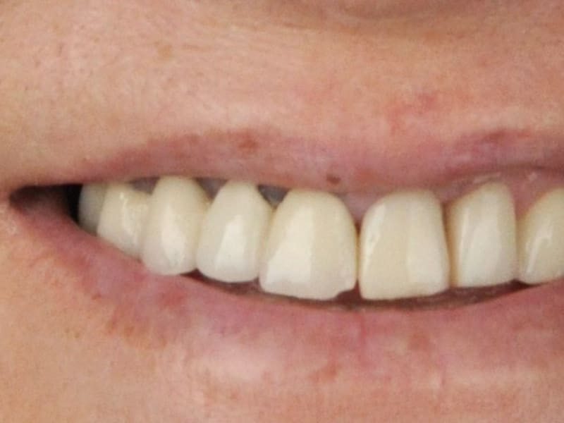 Before dental treatment - Patient case 2 showing initial condition