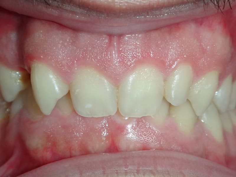 Before dental treatment - Patient case 1 showing initial condition