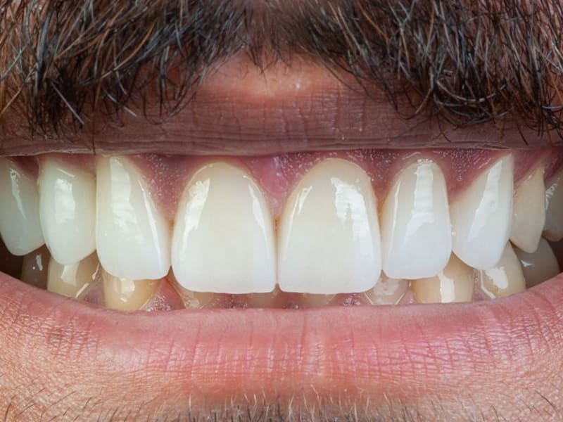 After dental treatment - Patient case 1 showing successful treatment results