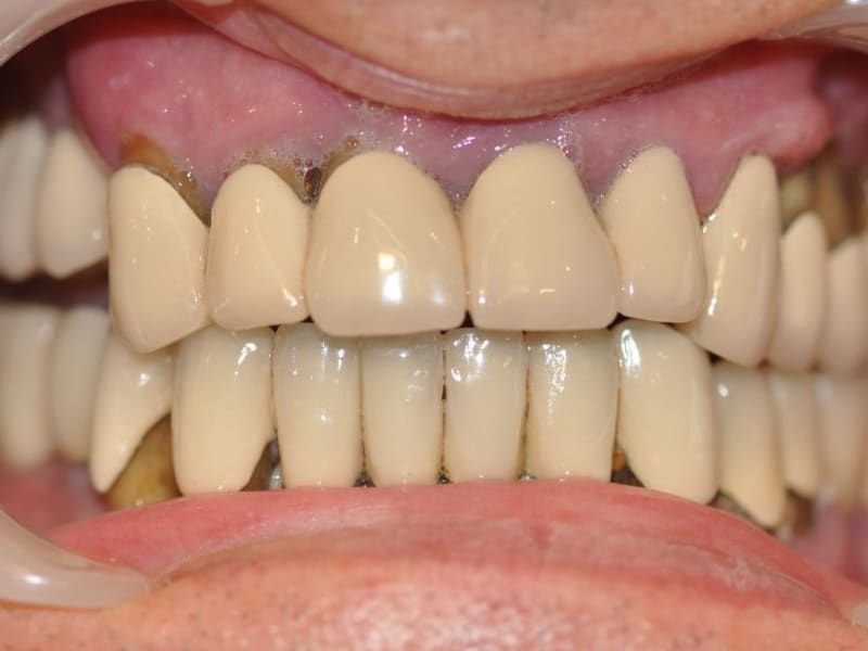 Before dental treatment - Patient case 1 showing initial condition