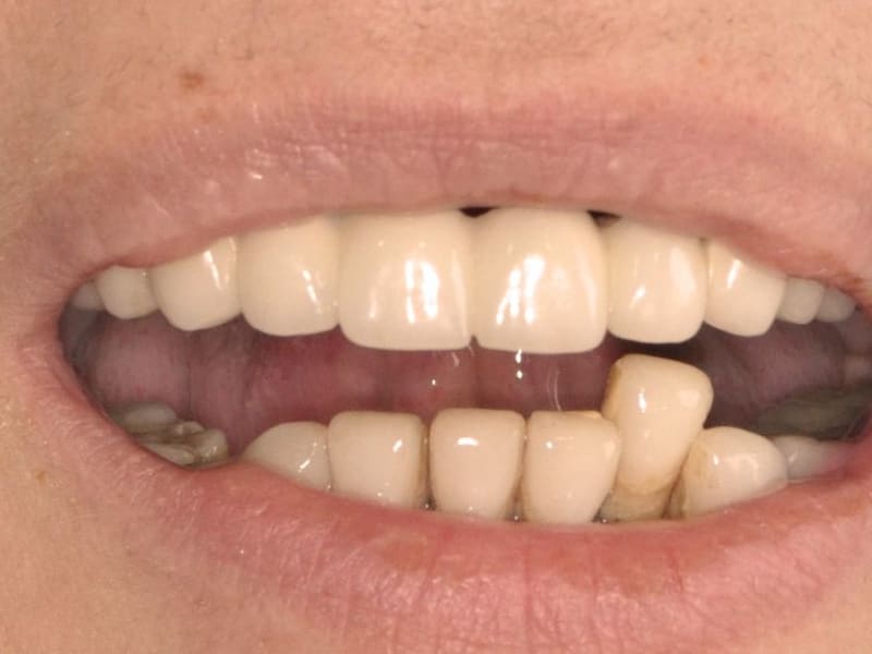 Before dental implant - Patient case 1 showing initial condition