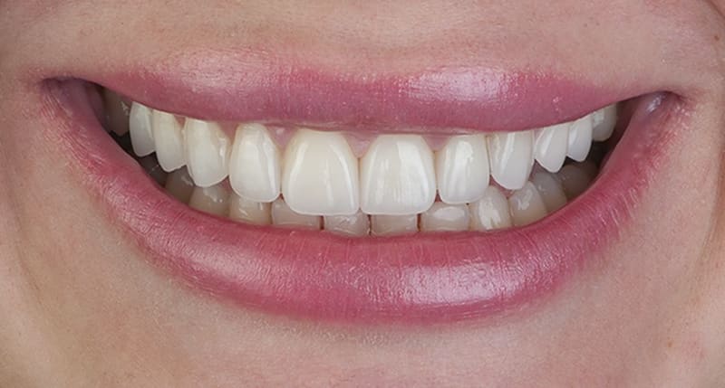 After dental treatment - Patient case 3 showing successful treatment results