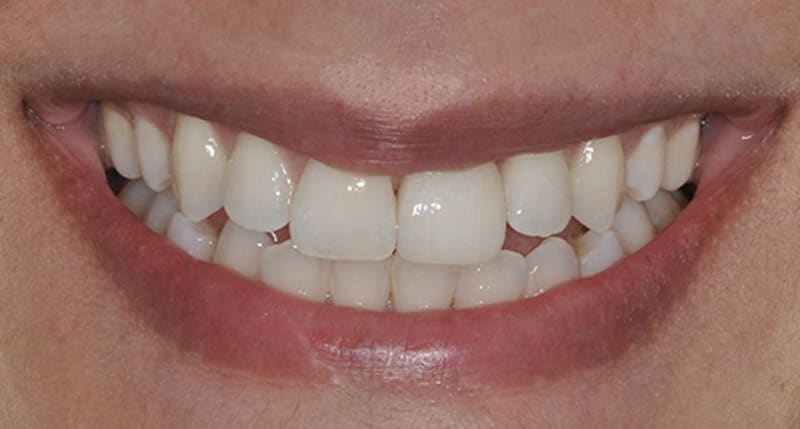 After treatment - Successful treatment results