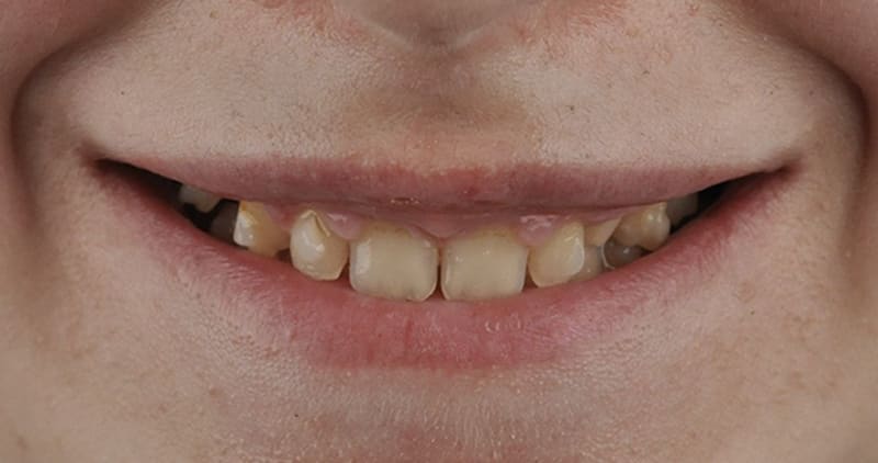 Before dental treatment - Patient case 3 showing initial condition