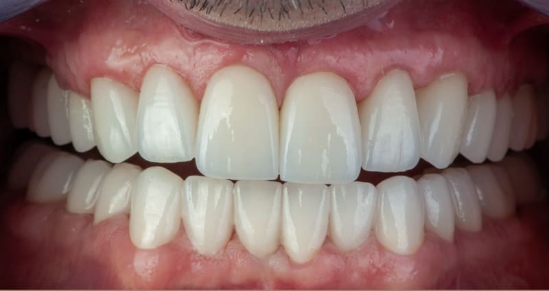 After dental treatment - Patient case 1 showing successful treatment results