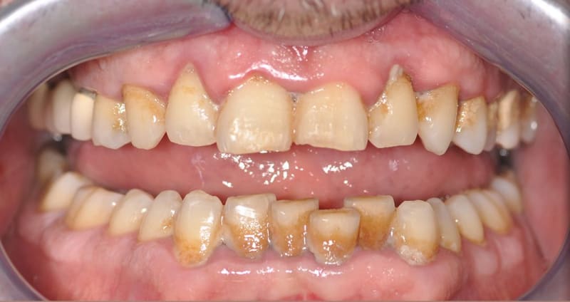 Before dental treatment - Patient case 1 showing initial condition