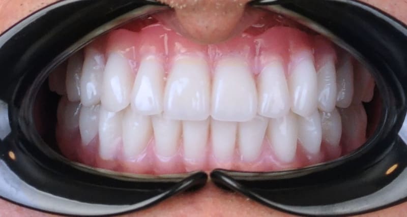 After dental treatment - Patient case 1 showing successful treatment results